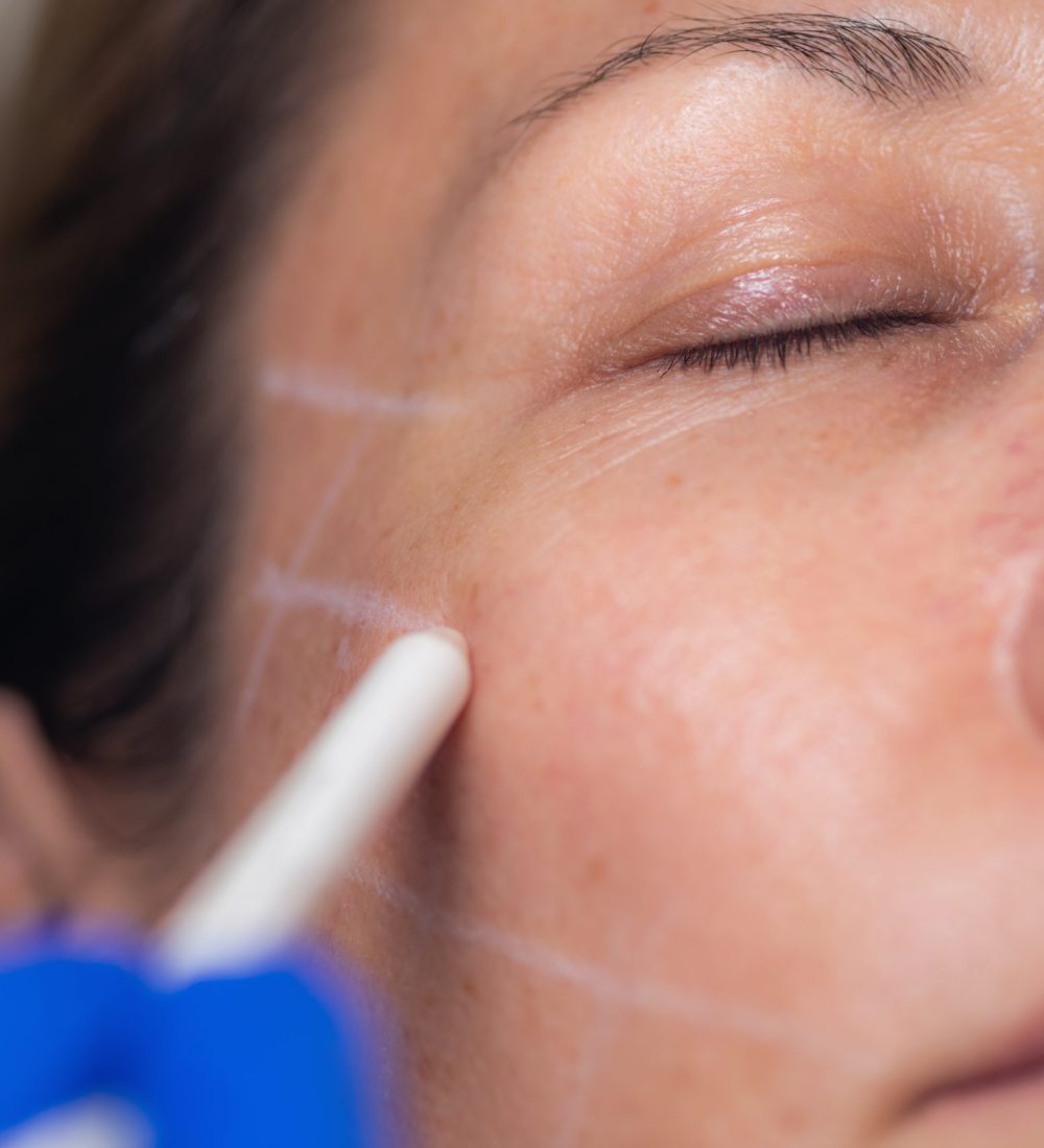 Woman Having Mesotherapy Treatment in Aesthetic Medicine Clinic